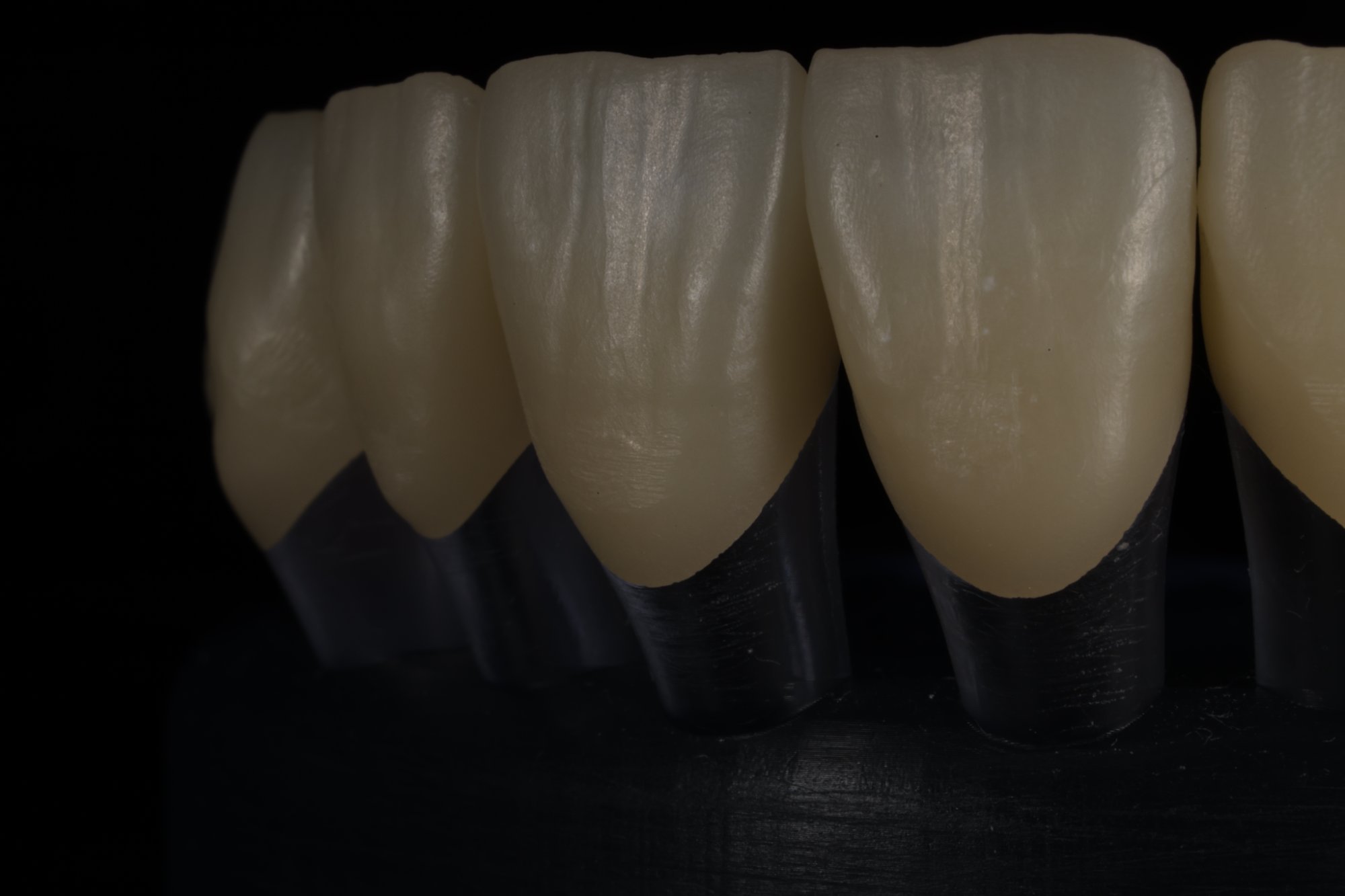 Anterior zirconia crowns