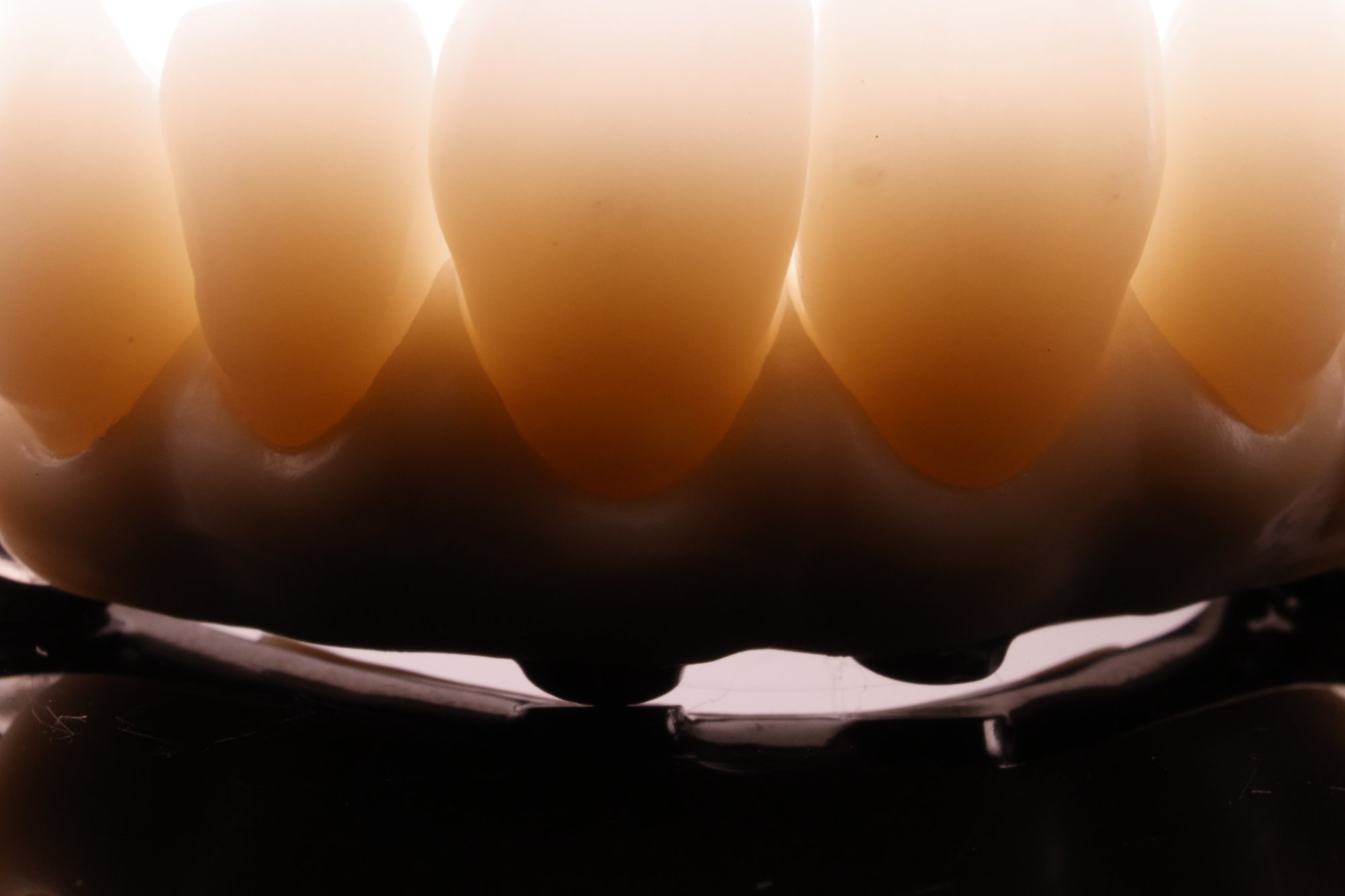 Backlit implant-retained crowns — macro detail