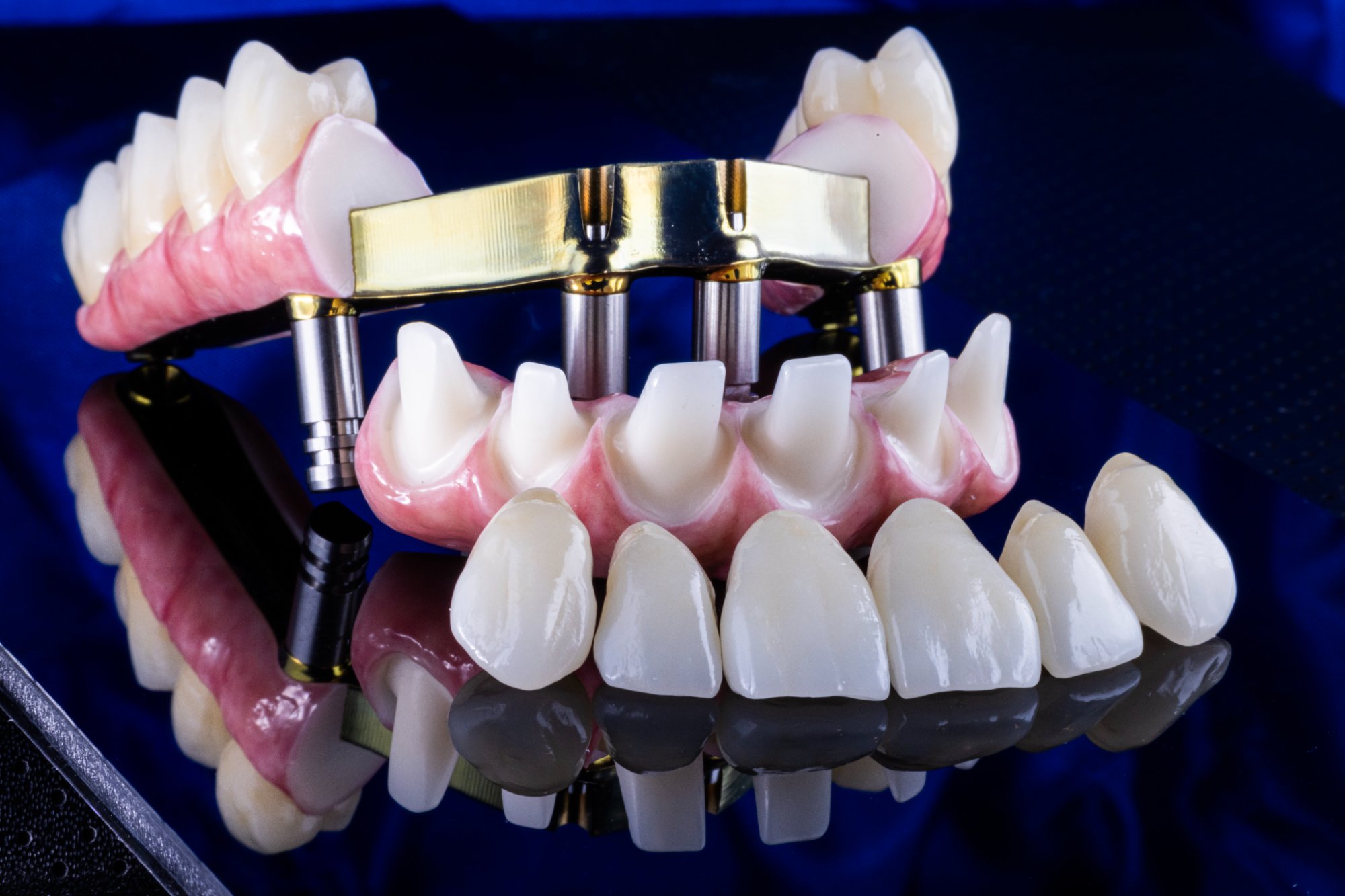 Full-arch All-on-X implant restoration