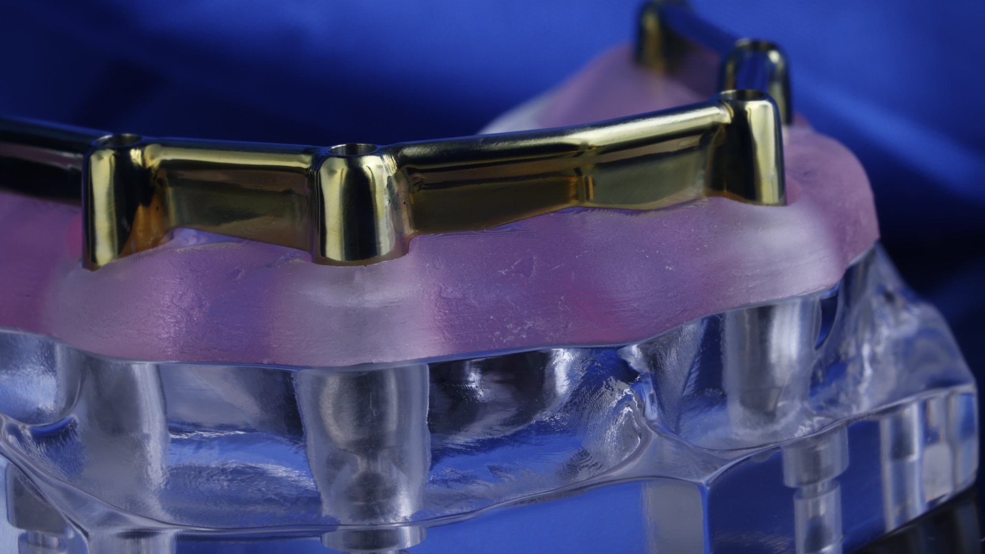 Bar-retained overdenture on model